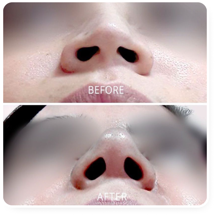 Resultado antes e depois