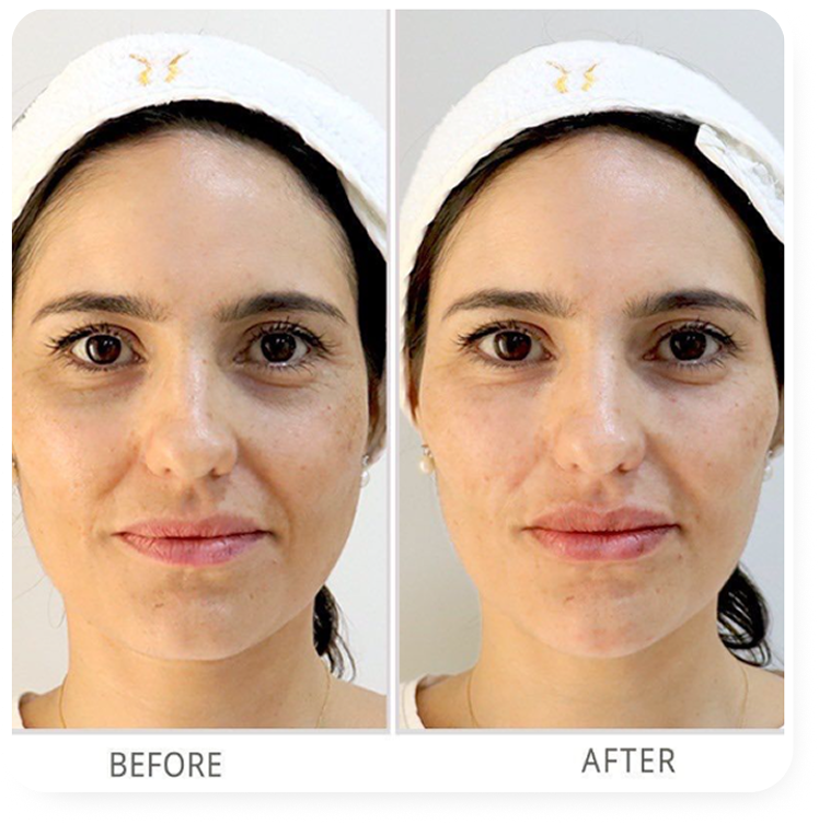Resultado antes e depois
